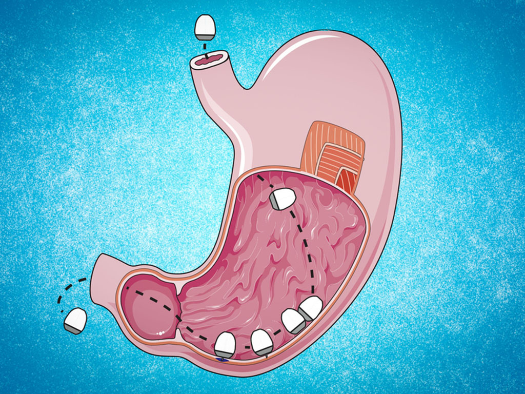 Illustration of a pill traveling through the digestive track