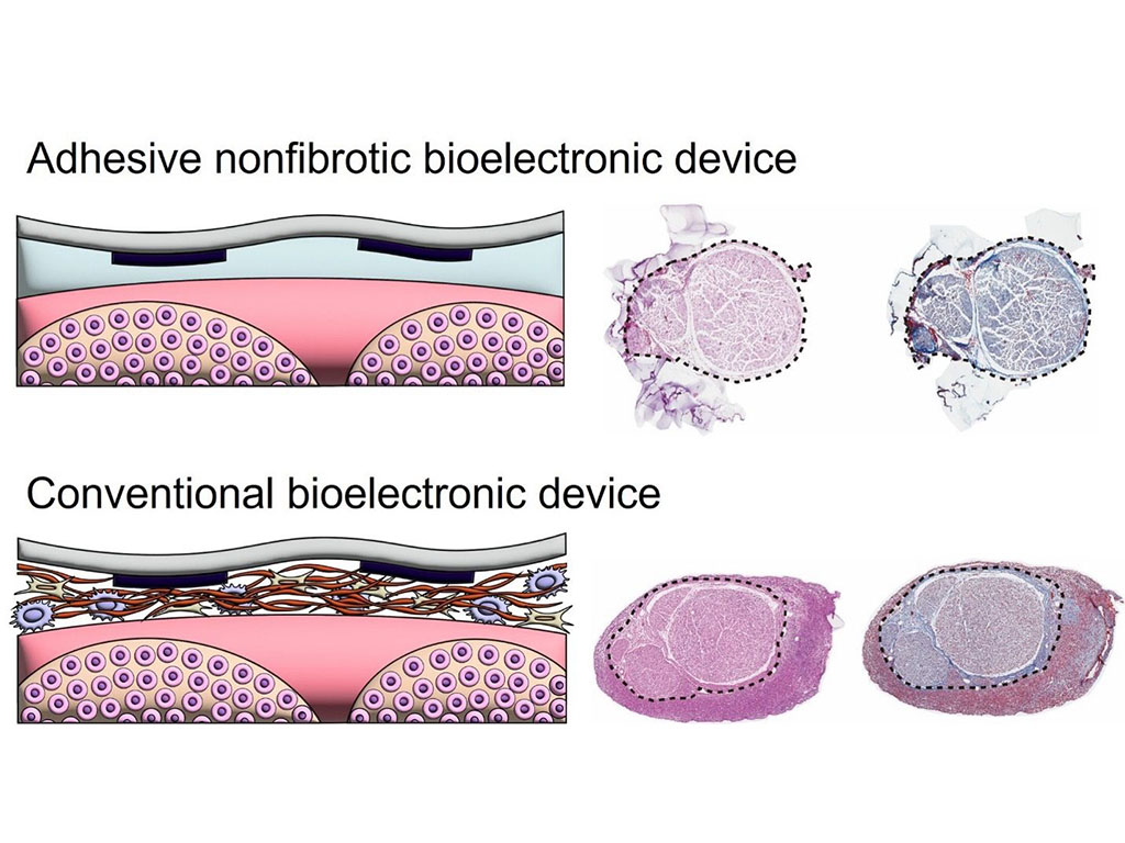 adhesive device comparison