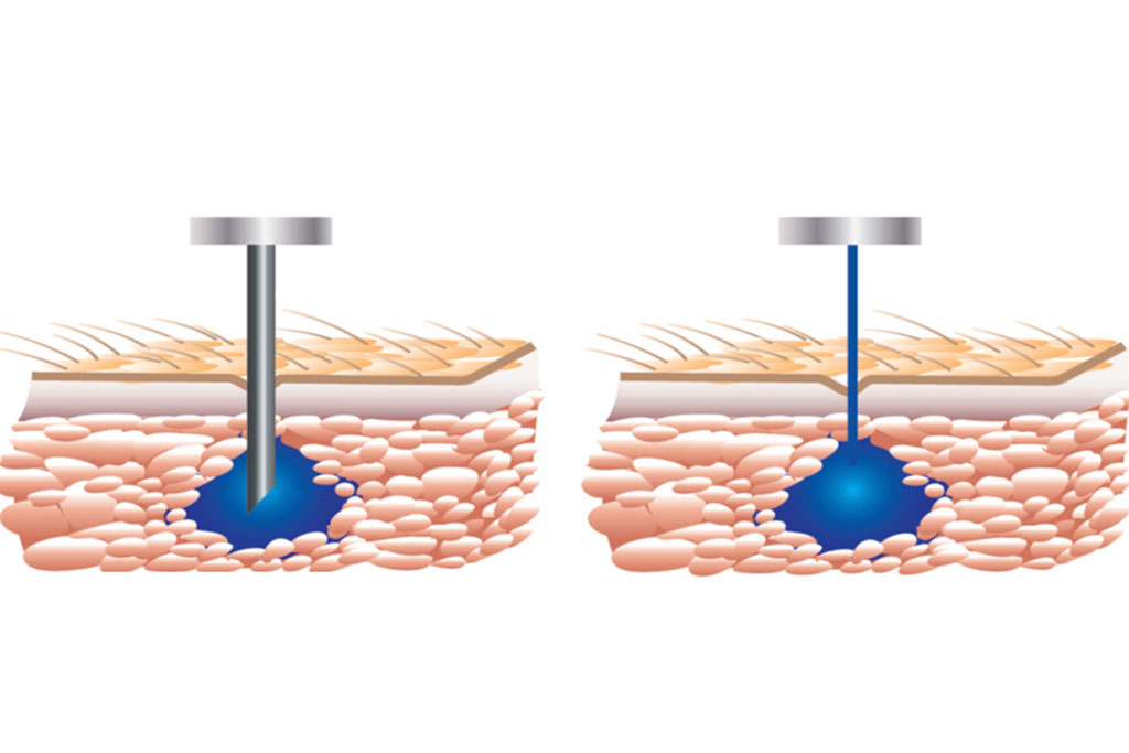 Startup s Needle free Drug Injector Gets Commercialization Deal MIT 